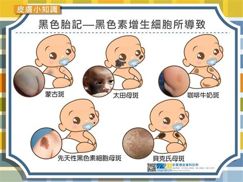 背上有胎記|認識7種常見胎記：有些會自然消失，有些可能產生併。